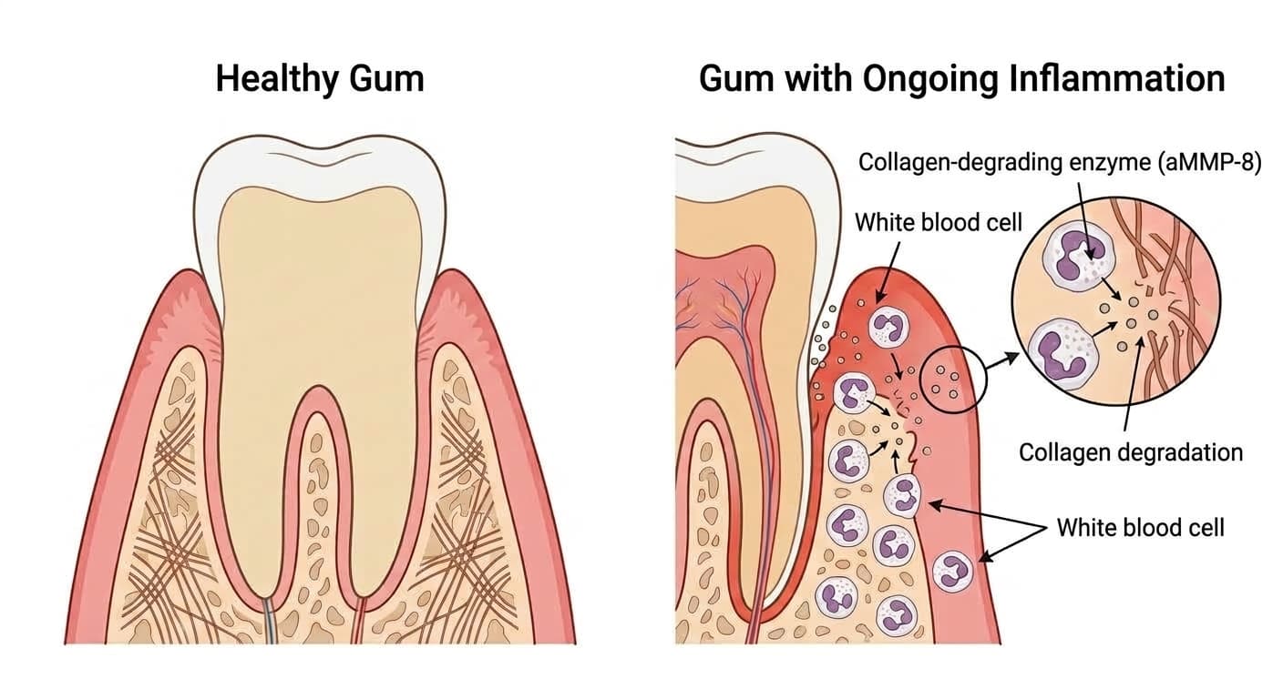 Cross-section comparing a healthy gum with an inflamed gum, showing white blood cells releasing the collagen-degrading enzyme aMMP-8