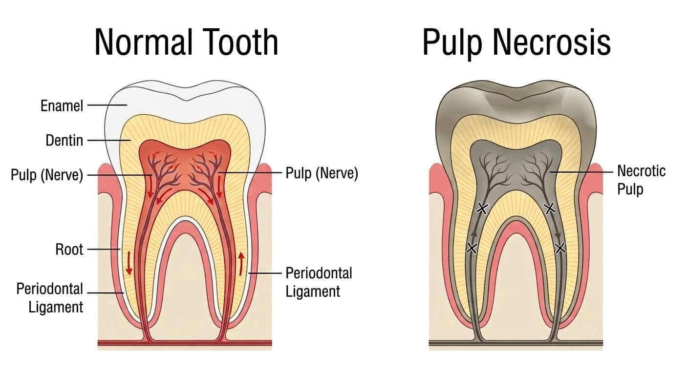 Cross-section comparison of a normal tooth and a tooth with pulp necrosis. In the normal tooth, blood flows through the pulp, but in the tooth with pulp necrosis, blood flow has stopped and the pulp has died, turning gray