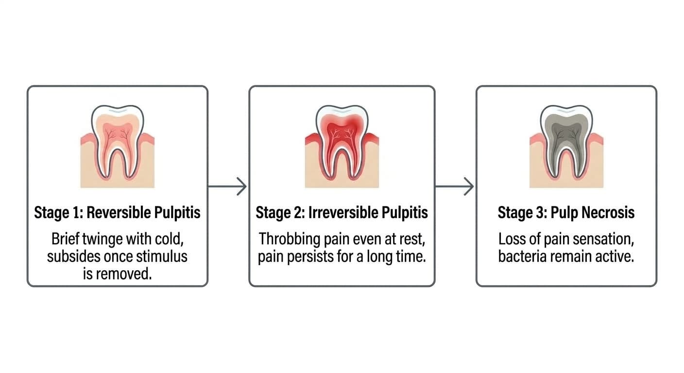 Flowchart of pulpitis progression: Stage 1 reversible pulpitis (brief sharp pain with cold, subsides once stimulus is removed), Stage 2 irreversible pulpitis (throbbing pain even at rest, pain persists for a long time), Stage 3 pulp necrosis (loss of pain sensation, bacteria remain active)