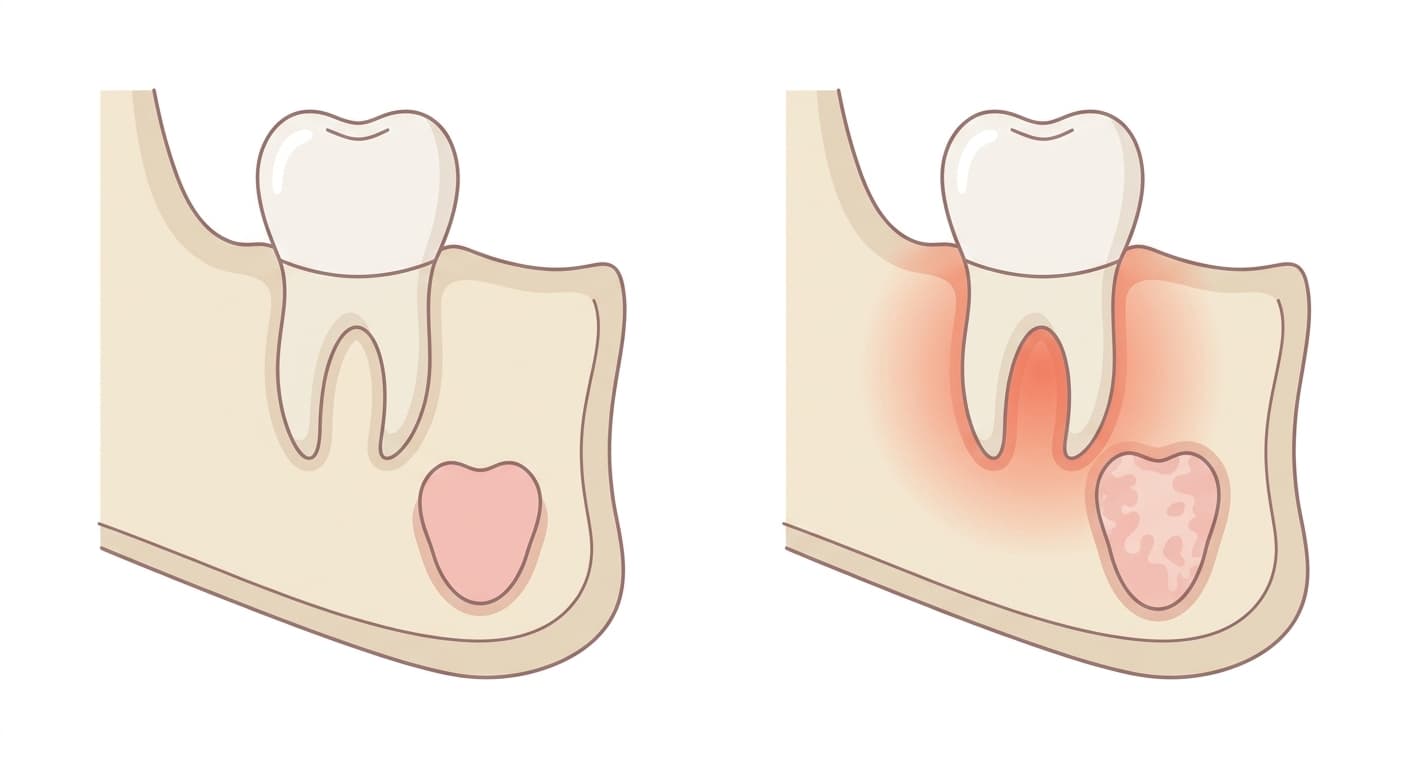 Side-by-side cross-section comparing a healthy baby tooth with its permanent tooth bud underneath to an inflamed baby tooth whose root tip has moved closer to the permanent tooth bud