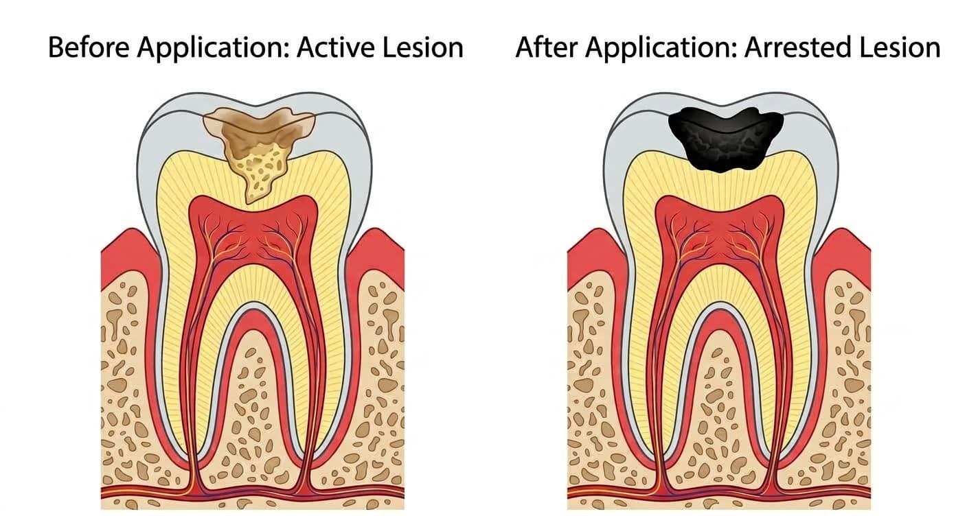 Cross-sectional diagrams of a tooth comparing a cavity lesion before and after two applications of SDF. Before application, the lesion appears soft and brown; after application, it appears hard and stained black.