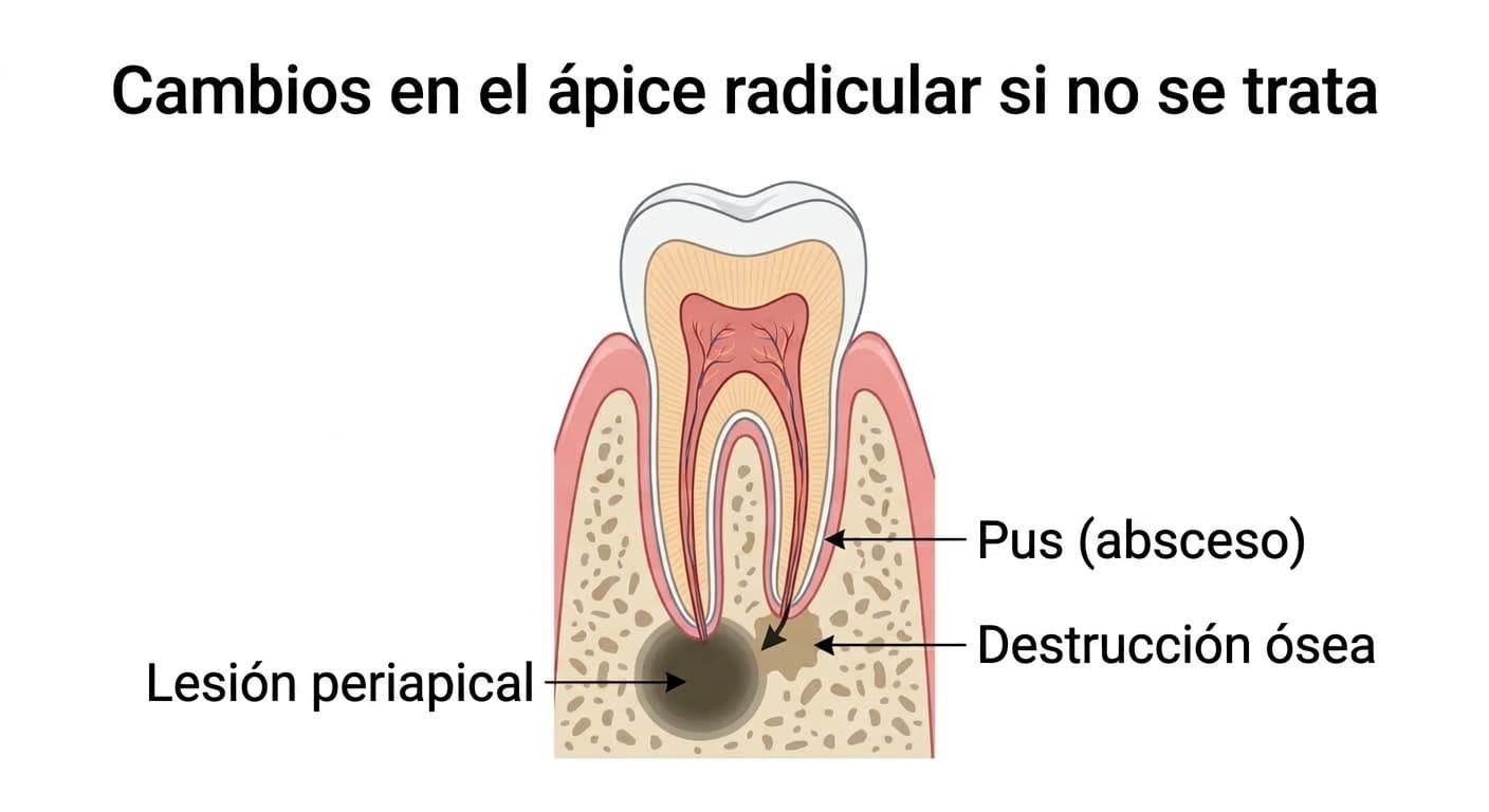 Corte transversal que muestra la lesión y el pus que la necrosis pulpar no tratada ha producido en el hueso del ápice radicular