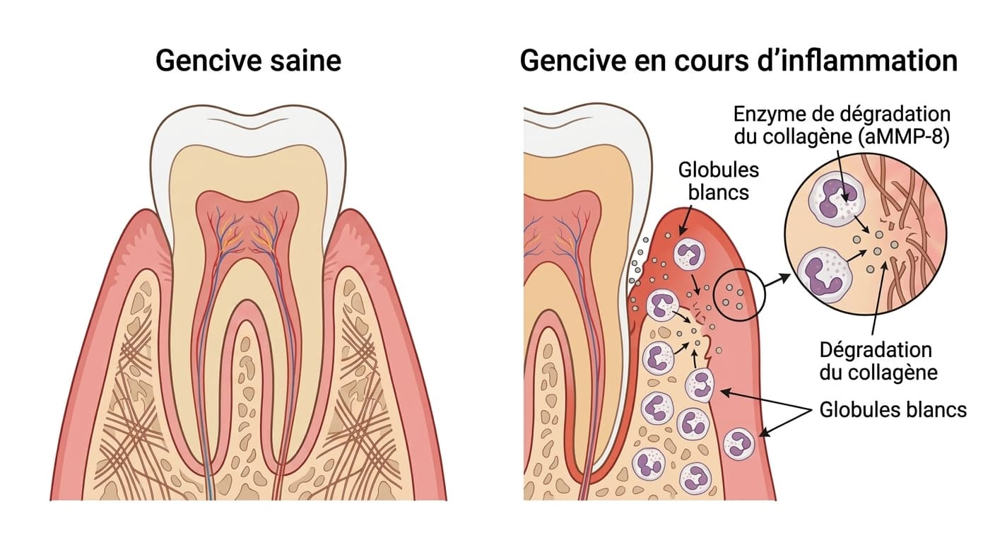 Coupe transversale comparant une gencive saine et une gencive en cours d'inflammation, montrant le processus par lequel les globules blancs libèrent l'enzyme de dégradation du collagène (aMMP-8)