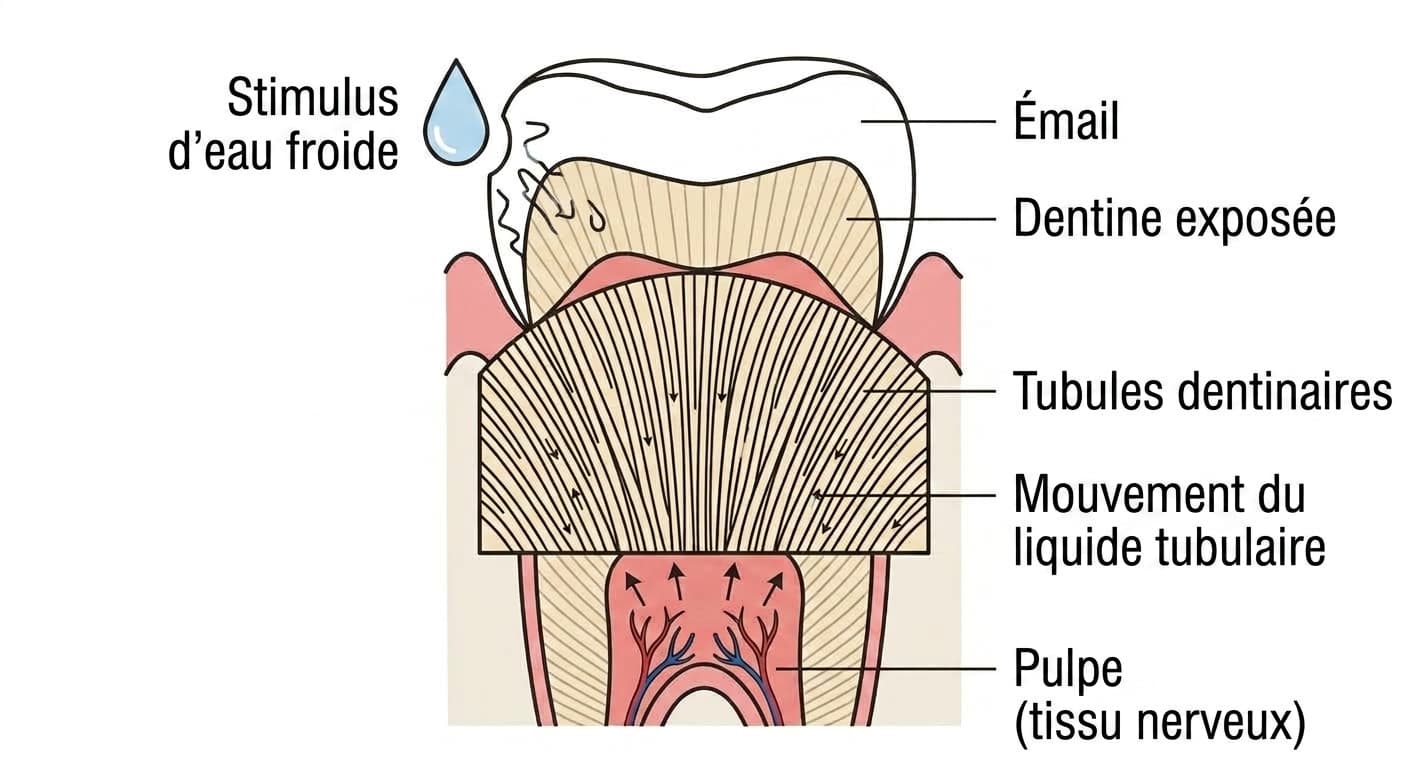 Mécanisme de la douleur dans l'hypersensibilité dentinaire. Lorsqu'un stimulus d'eau froide touche la surface de dentine exposée, le liquide contenu dans les tubules dentinaires se déplace, et ce mouvement stimule le nerf de la pulpe, générant un signal de douleur