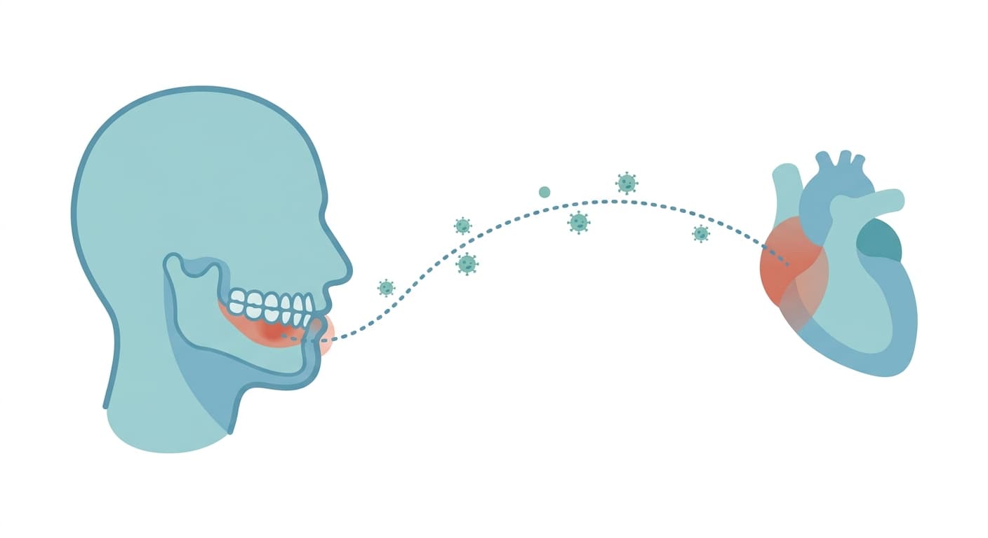 Schéma montrant des bactéries provenant d'une zone d'inflammation gingivale se déplaçant par la circulation sanguine jusqu'au cœur