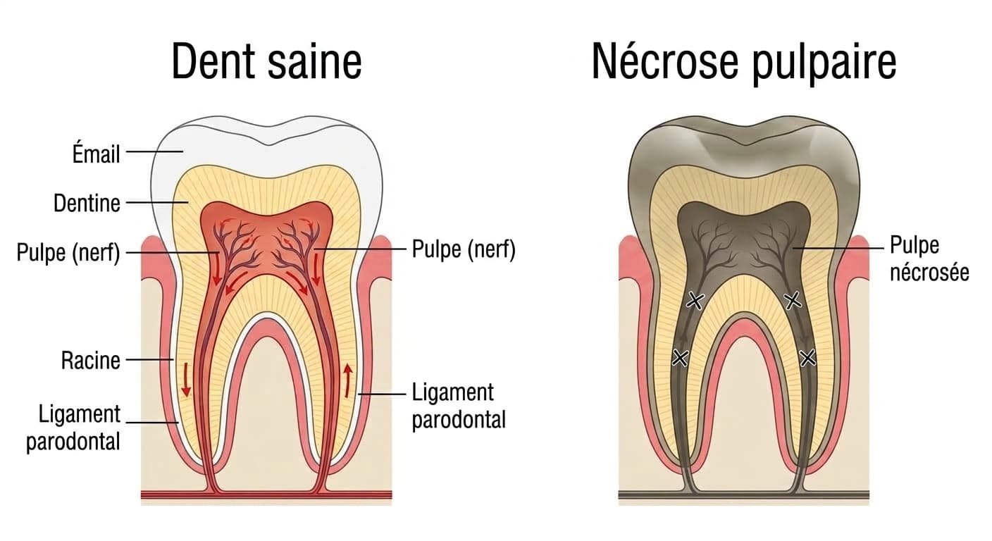 Comparaison en coupe d'une dent saine et d'une dent atteinte de nécrose pulpaire. Dans la dent saine, le sang circule dans la pulpe, tandis que dans la dent nécrosée, la circulation est interrompue et la pulpe, grise, est morte.