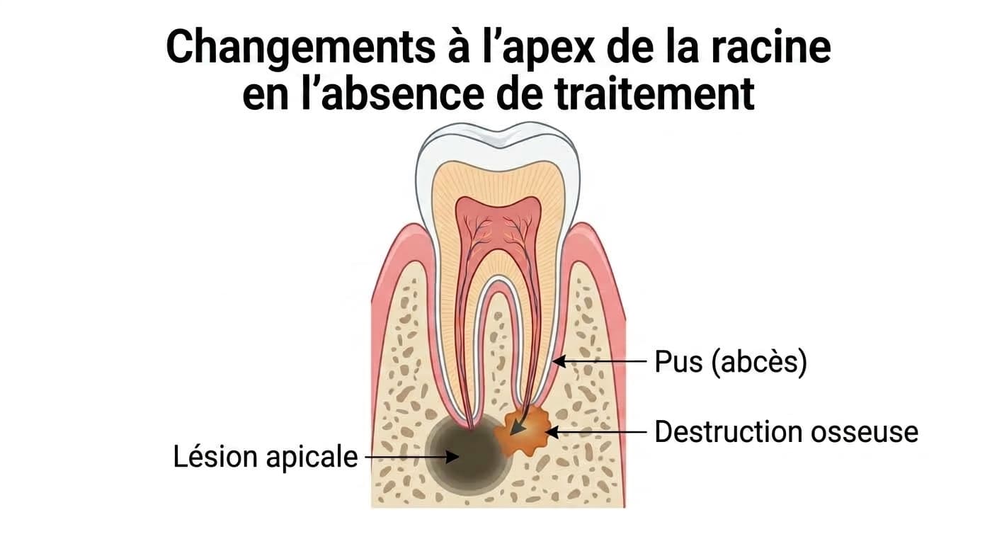 Coupe montrant la lésion osseuse et le pus formés à l'apex de la racine par une nécrose pulpaire non traitée.