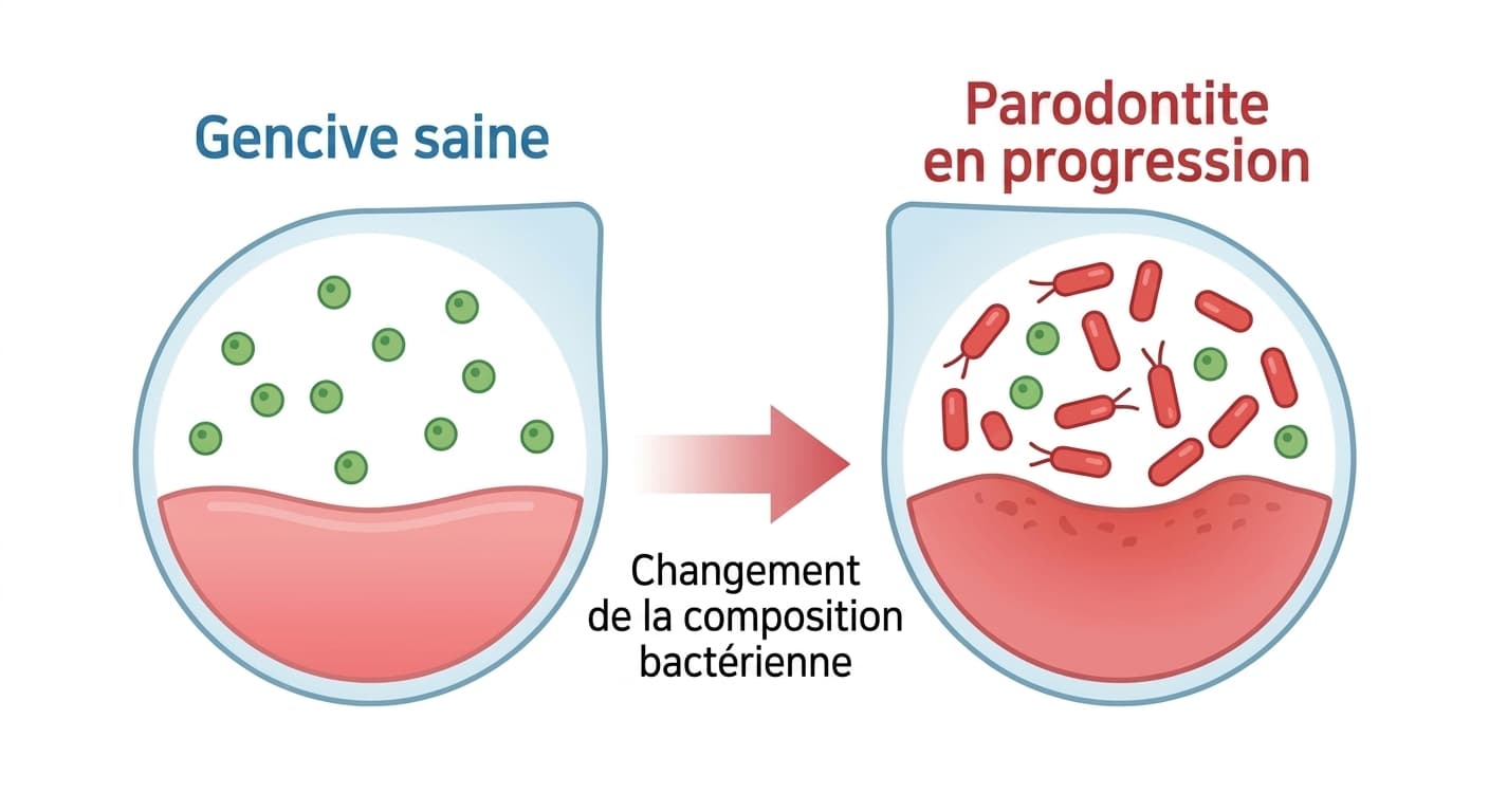 Illustration comparant la composition bactérienne d'une gencive saine et d'une gencive atteinte de parodontite. Du côté sain, des bactéries vertes sont réparties uniformément ; du côté atteint de parodontite, des bactéries rouges ont fortement augmenté.
