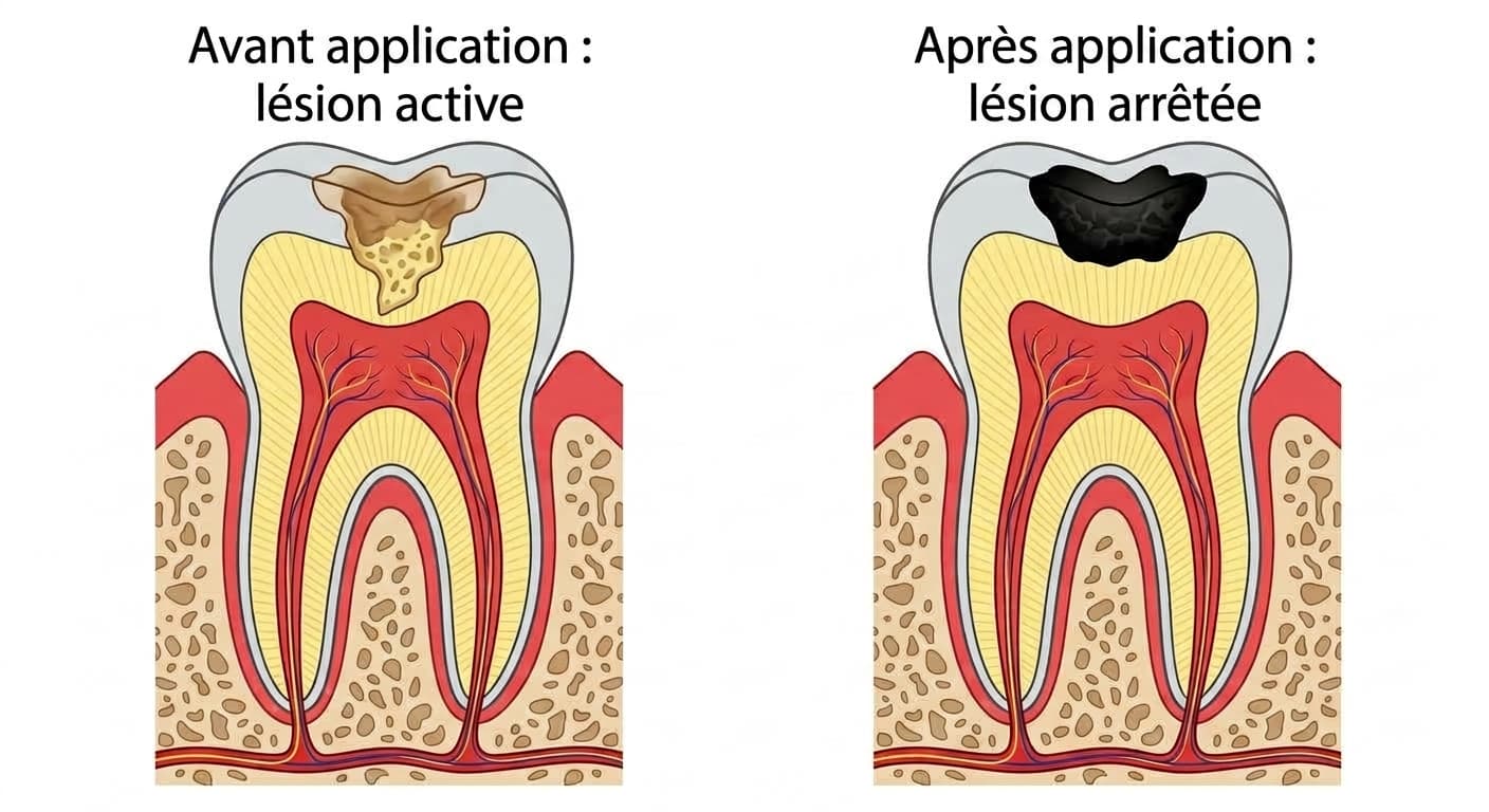Coupe transversale d'une dent comparant la lésion carieuse avant application du SDF et après deux applications. Avant, la lésion est ramollie et brunâtre ; après, elle apparaît durcie et noircie.