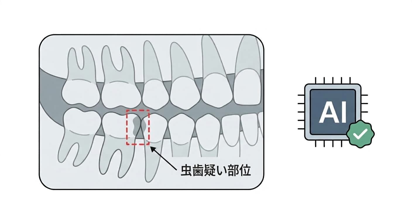 歯科用レントゲン写真でAIが虫歯疑いの部位を示す概念図