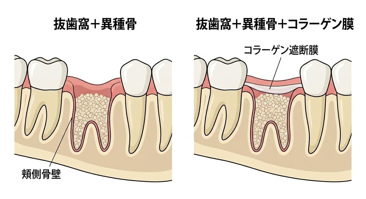 抜歯部位に異種骨粒子のみを詰めた場合と、異種骨の上にコラーゲン遮断膜を重ねた場合を並べて示す抜歯窩の断面図