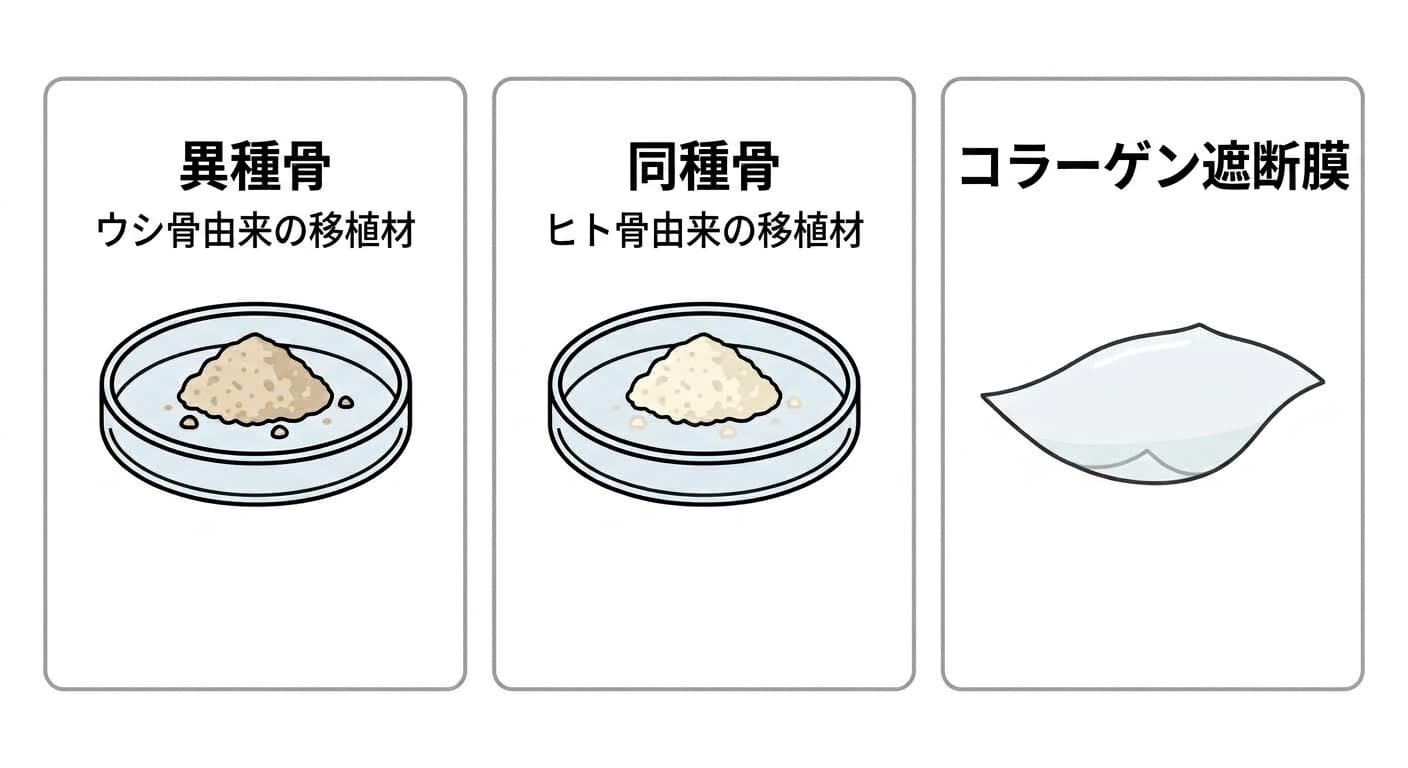 ウシ骨由来の異種骨粒子、ヒト骨由来の同種骨粒子、コラーゲン遮断膜を並べて各材料の役割を示す図