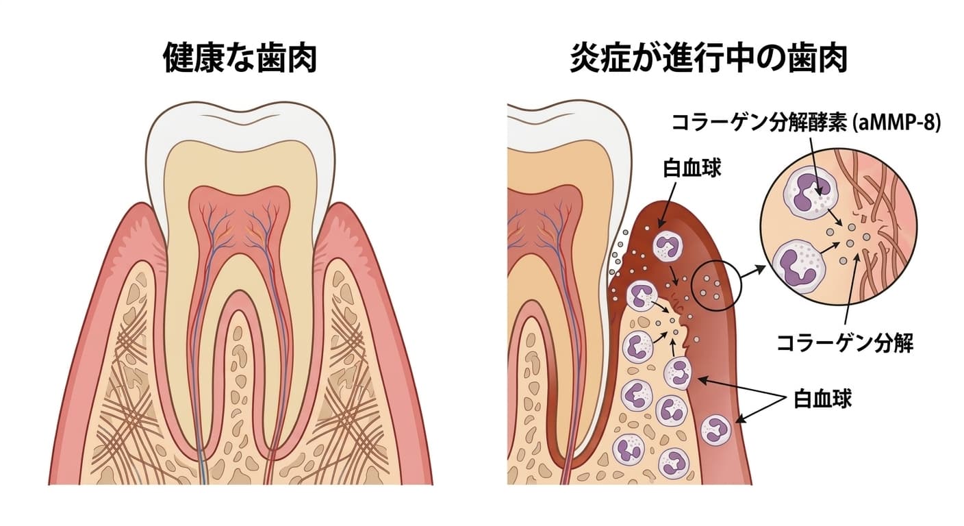 健康な歯肉と炎症が進行中の歯肉で、白血球がコラーゲン分解酵素(aMMP-8)を放出する過程を比較した断面図