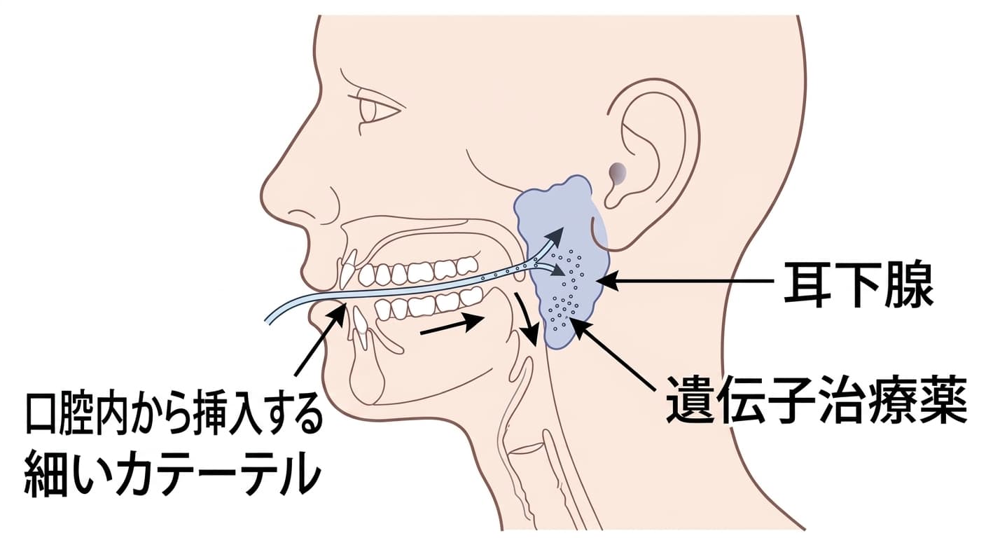 頬の内側の奥歯の脇にある耳下腺の開口部から細いカテーテルを挿入し、遺伝子治療薬を耳下腺内に直接注入する投与方法を示した図