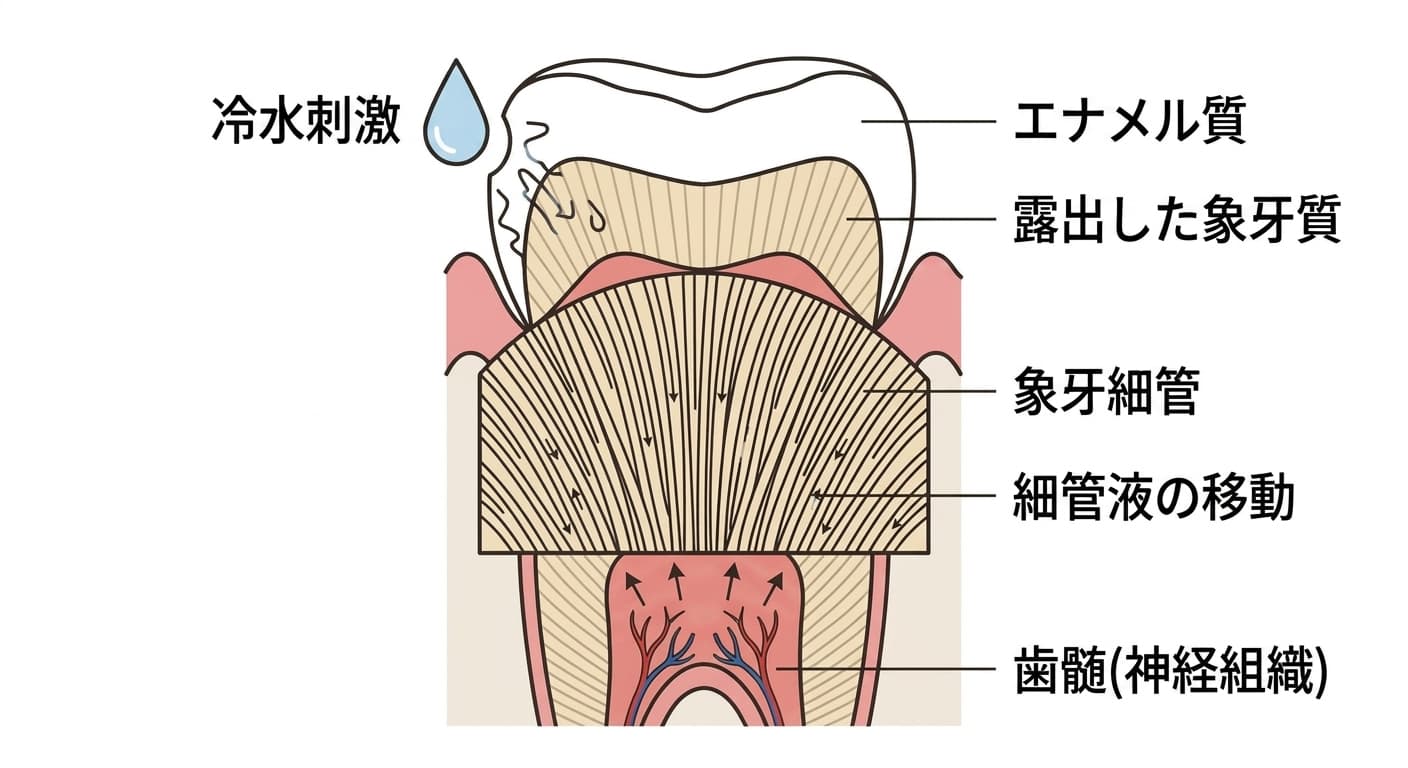 象牙質知覚過敏症の痛み発生のメカニズム。冷水刺激が露出した象牙質表面に触れると象牙細管内の液体が動き、その動きが歯髄の神経を刺激して痛みの信号として伝わる