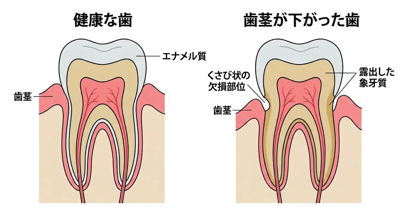 健康な歯と歯茎が下がった歯の断面比較。健康な歯は歯茎が歯の首の部分を覆っているが、歯茎が下がった歯は根元側の象牙質が露出し、歯茎との境目にくさび状に欠損した部位が生じることがある