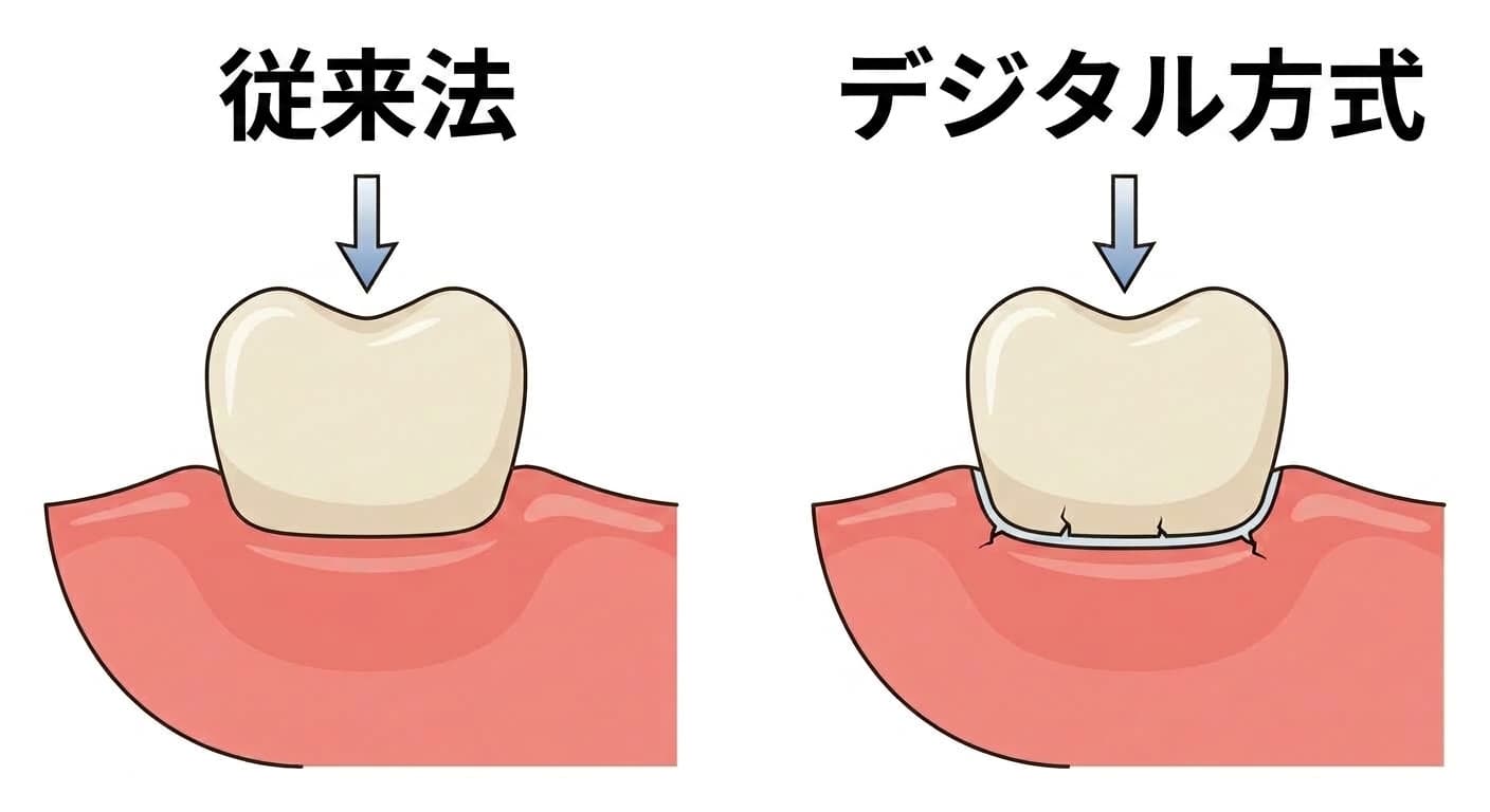 歯と入れ歯の床が接する部分の断面を二つの方式で比較した図。左の従来法は境界線なく一体になめらかにつながっており、右のデジタル方式は接着剤層の境界線に沿って小さな亀裂が生じている