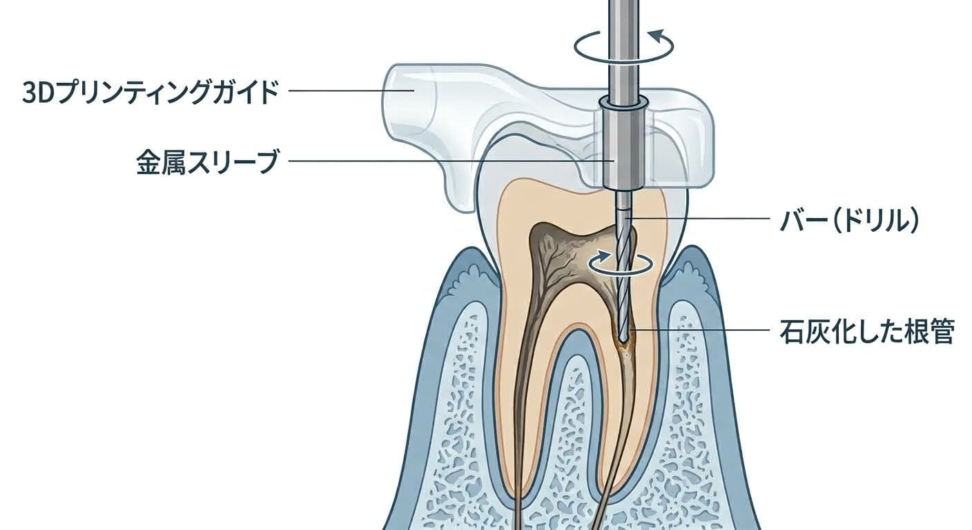 3Dプリンティングガイドに挿入された金属スリーブに沿って、バーが石灰化した根管入口まで導かれる様子