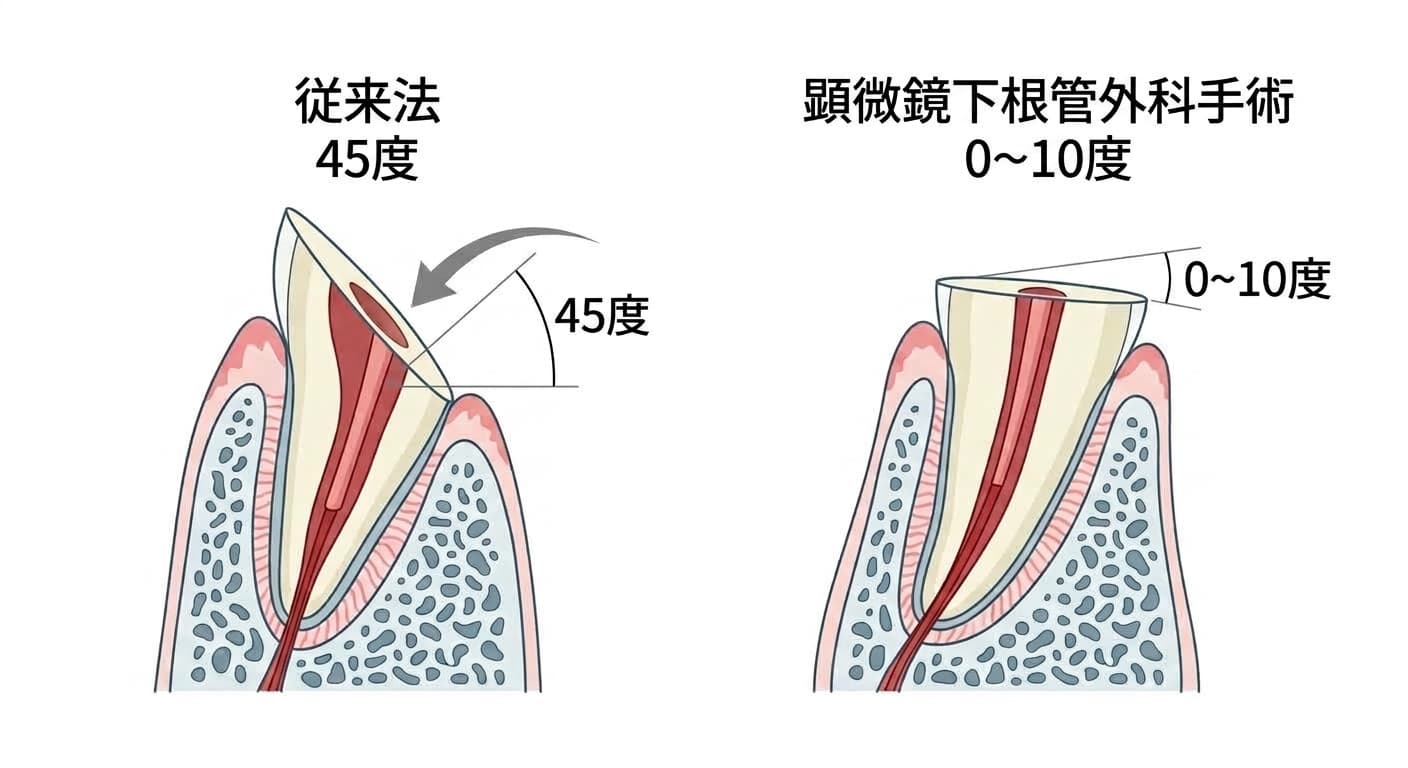 根尖切除術の傾斜角を、従来法の45度と顕微鏡下根管外科手術の0~10度で比較した断面図