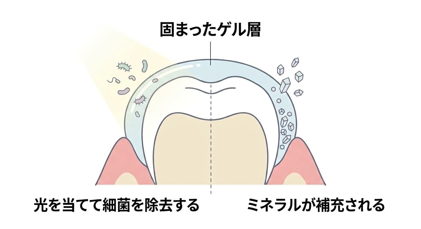 固まったゲル層に光が当たり細菌が消える様子と、その下の歯根表面に新しいミネラル結晶が満たされる様子を合わせて示す断面図