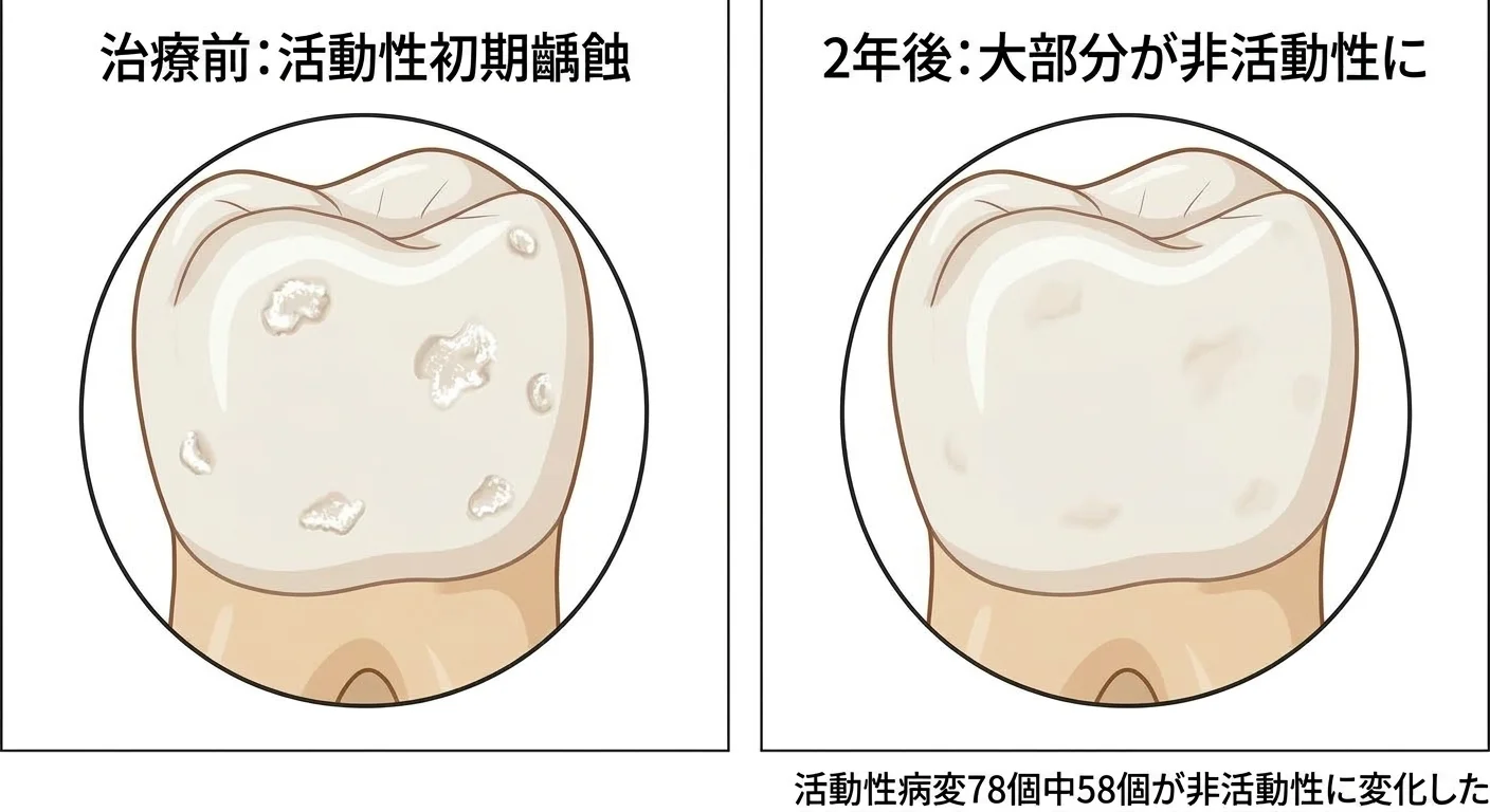 治療前は活動性初期う蝕で白い斑点が複数あった歯と、2年後に斑点の大部分が薄くなった同じ歯を比較した図