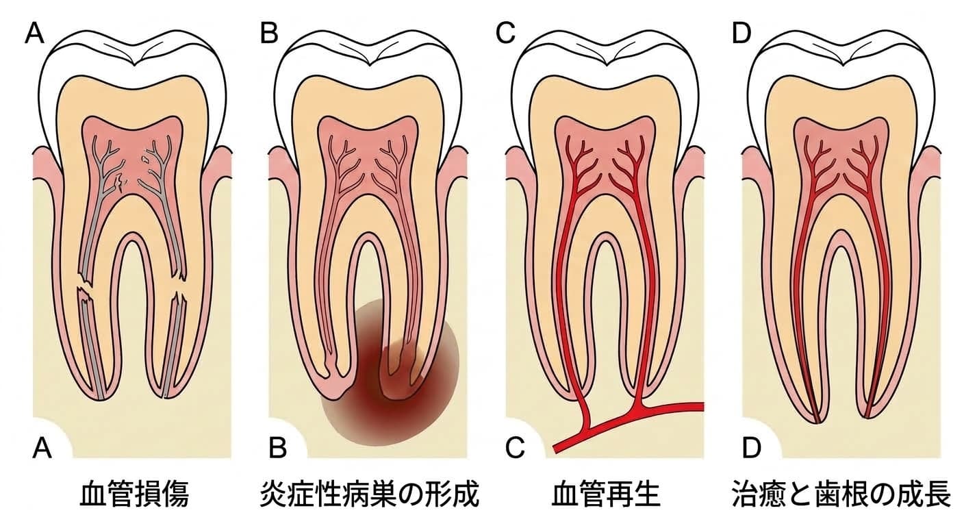 外傷後に歯髄が壊死した歯の根の先で、血管が断裂したのち再び伸びて入り込み治癒していく4段階の過程を示す模式図
