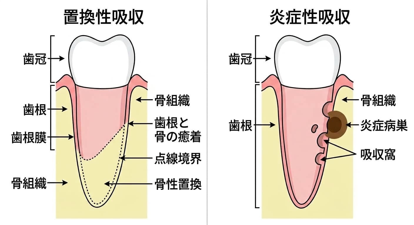 歯根が徐々に骨組織へ置き換わる置換性吸収と、歯根表面が欠けて炎症病巣が生じる炎症性吸収を並べて比較した模式図
