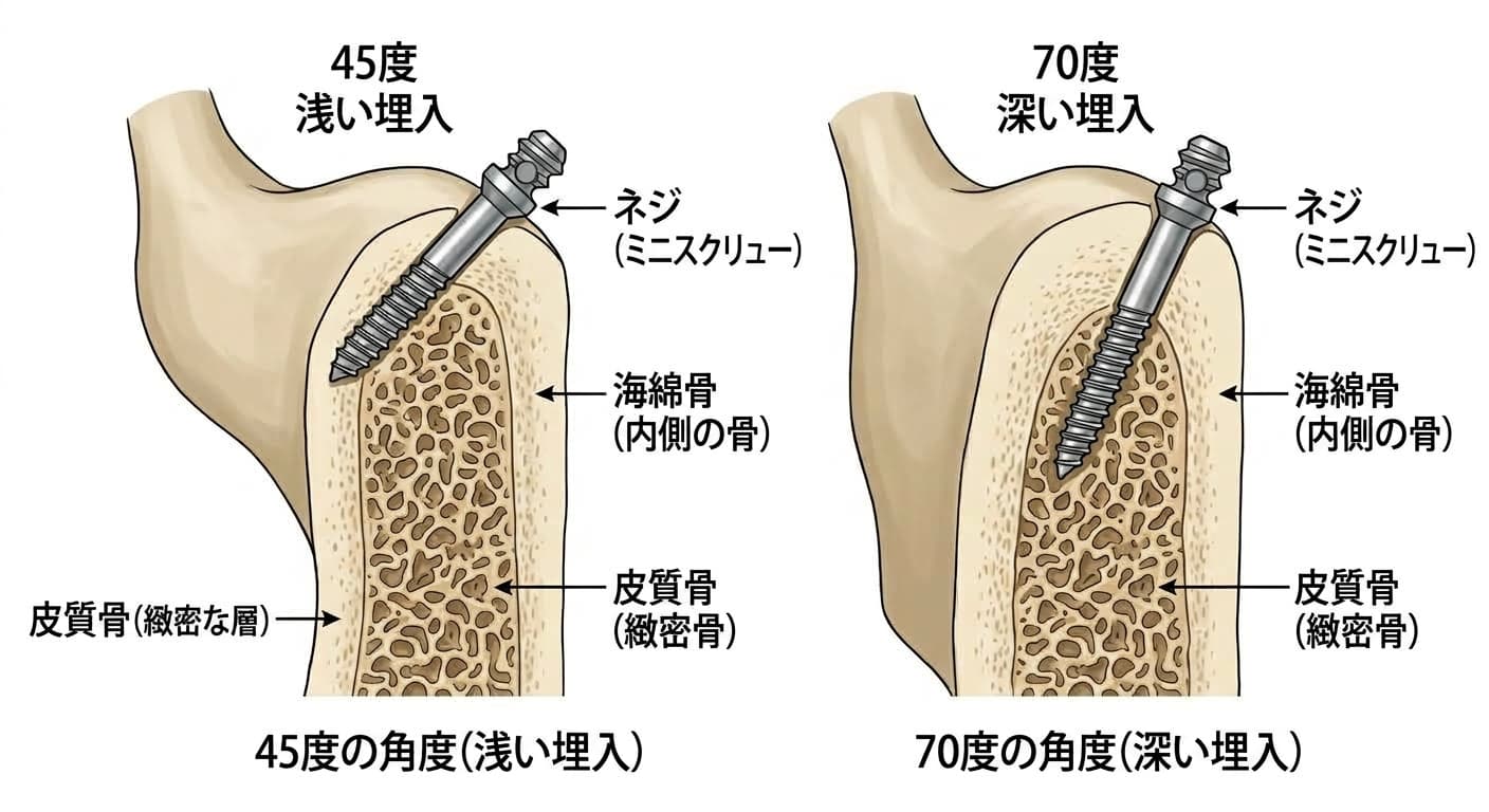 同じ歯槽骨にネジを45度と70度でそれぞれ斜めに埋入し、70度で埋入したネジがより厚い皮質骨層を貫通する様子を比較した図解