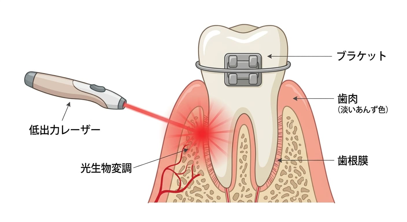 低出力レーザー機器が、ブラケットが付いた歯の隣の歯肉(歯根膜)に赤い光を照射している断面図。光生物変調が起こる部位を矢印で示している