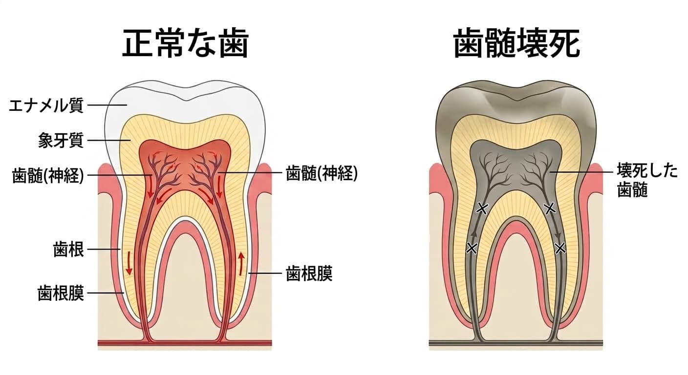 正常な歯と歯髄壊死の歯の断面比較。正常な歯では歯髄に血流が流れているが、歯髄壊死の歯では血流が途絶え、歯髄が灰色になって壊死している