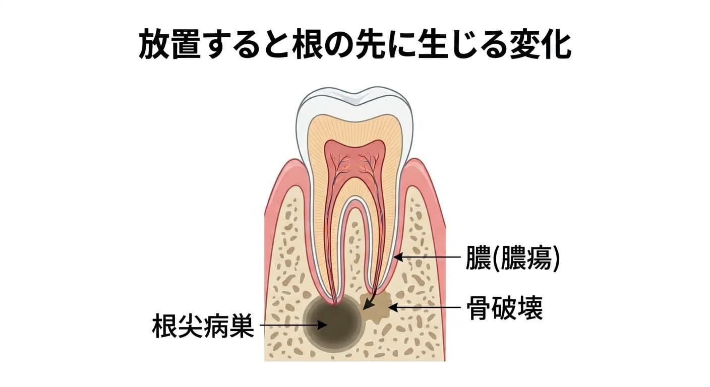 放置された歯髄壊死が根の先の骨に作った病巣と膿を示す断面図