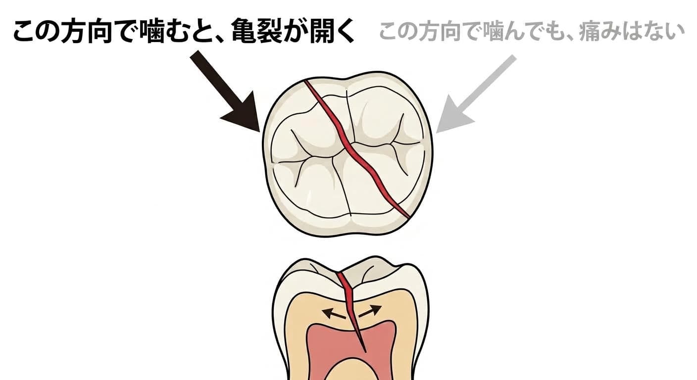 臼歯の咬合面のひび割れ線と、噛む方向によって痛みが現れたり現れなかったりする理由、断面でひびが開く様子を示す図