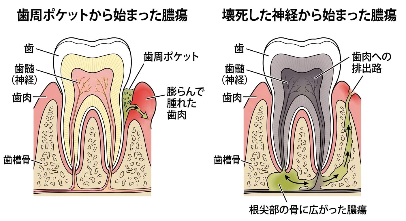 歯周ポケットから始まった膿瘍と壊死した神経から始まった膿瘍を比較した歯の断面概念図