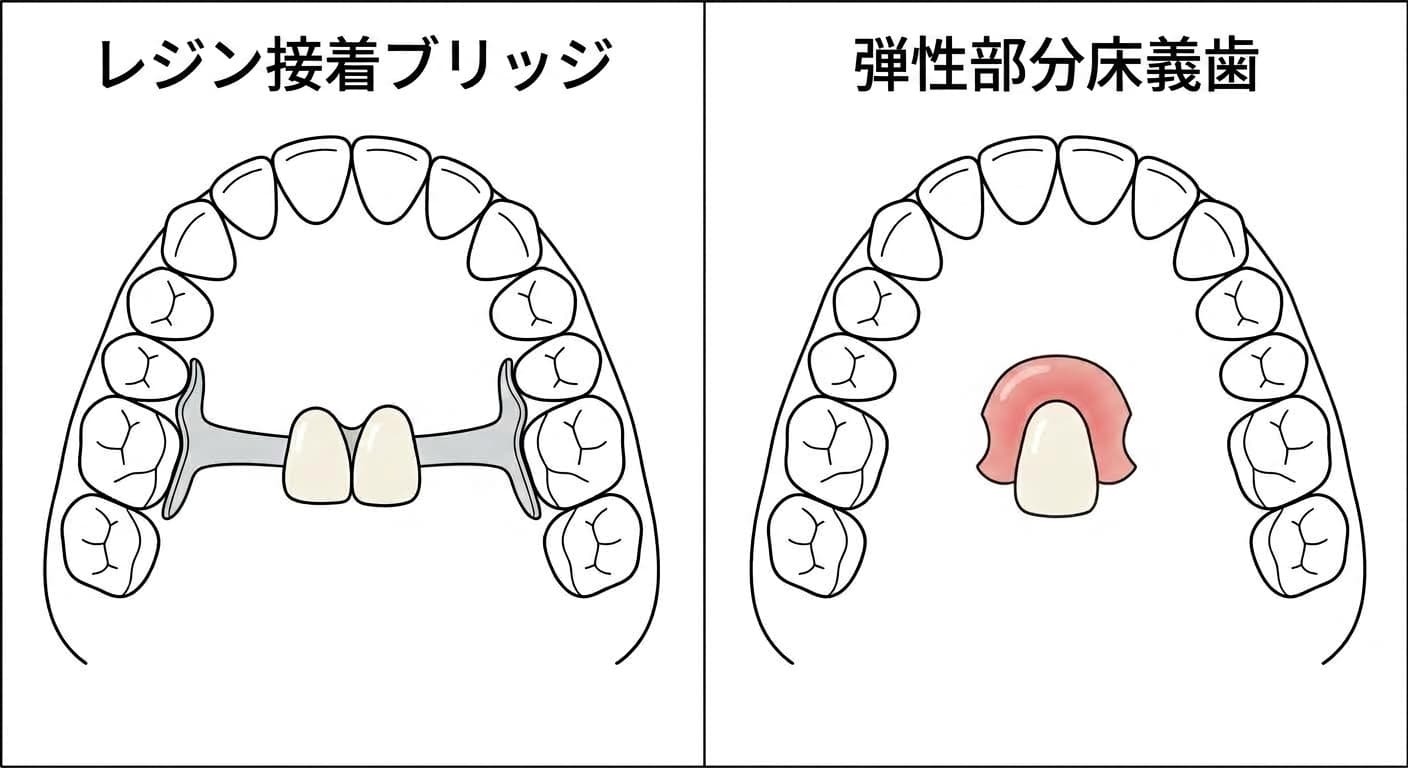 1本の歯がない部位を管理する2つの方法を比較した図。左は両隣の歯の裏面に接着するレジン接着ブリッジ、右は金属のクラスプなしで着脱できる弾性部分床義歯を示す
