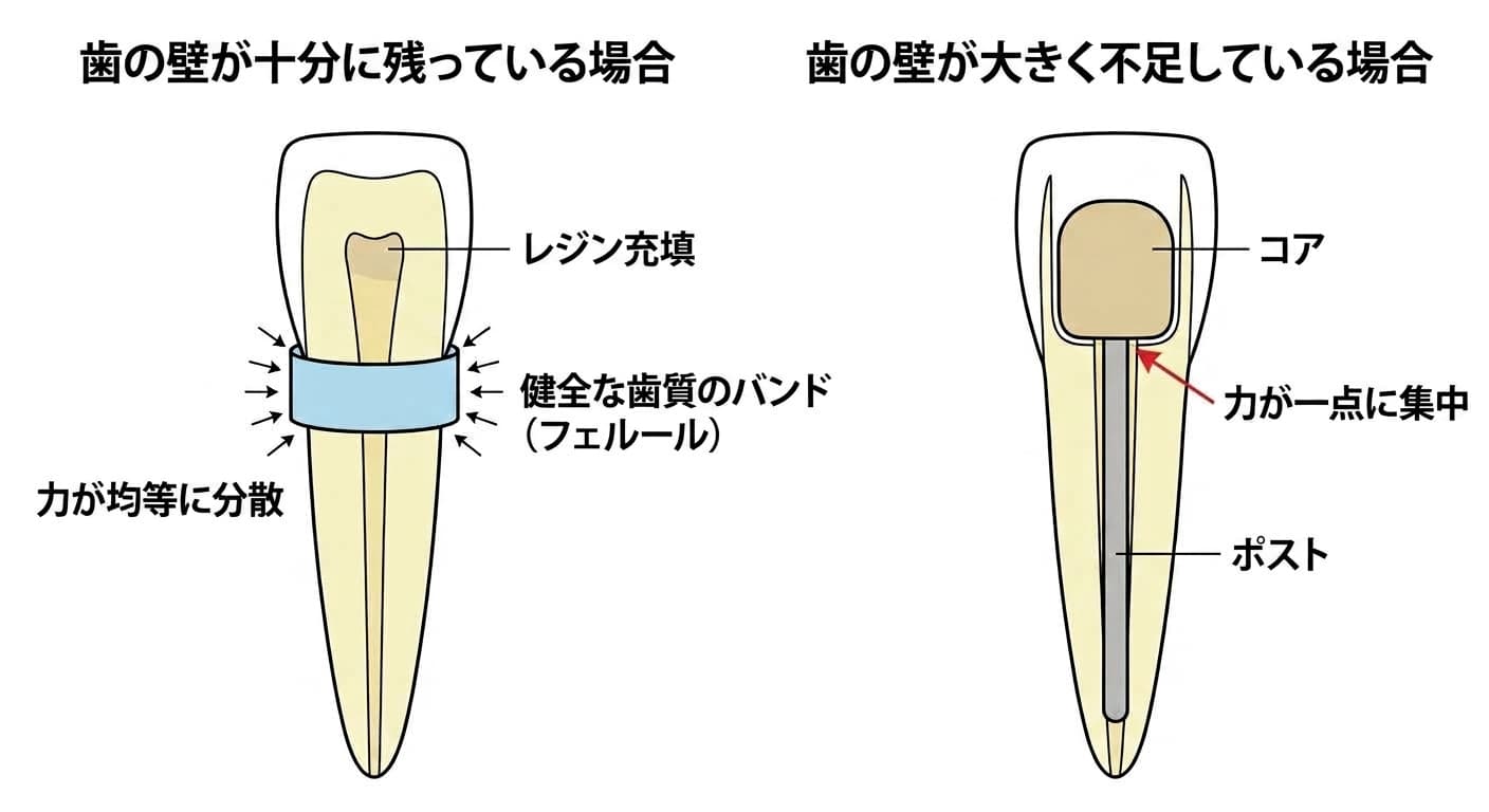 神経治療をした前歯で歯の壁が十分に残っている場合と大きく不足している場合、力が伝わる様子を比較した断面図