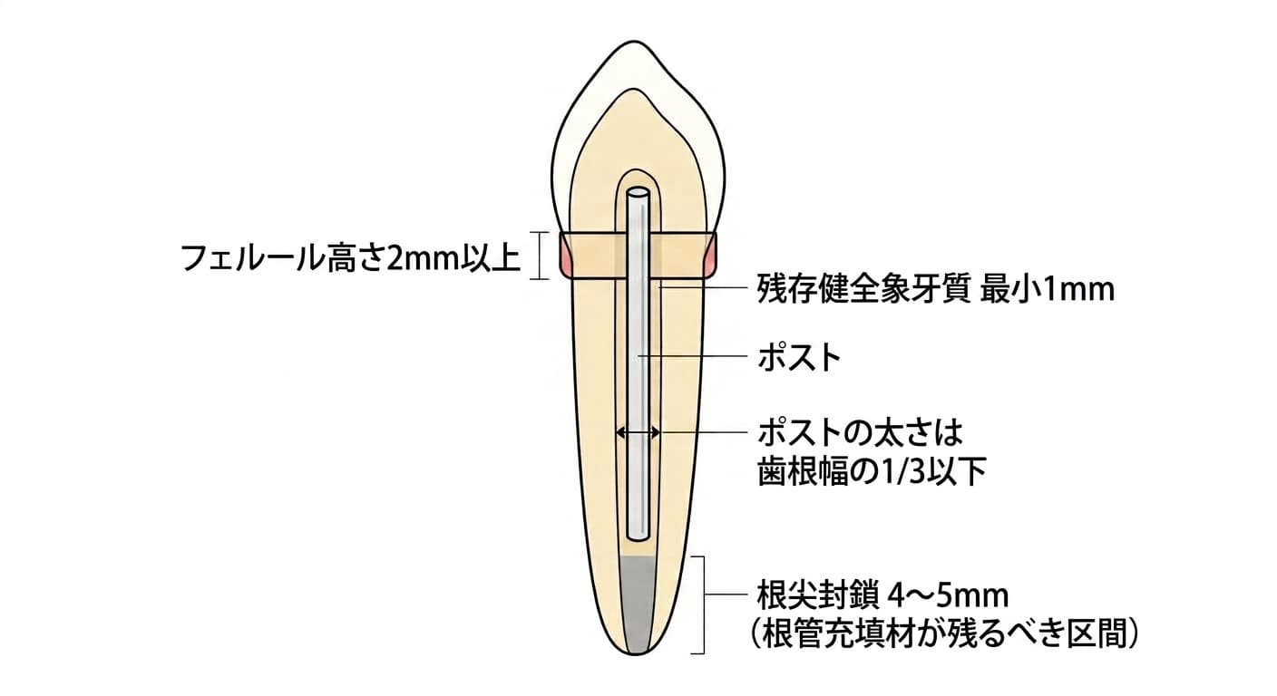 神経治療をした前歯にポストを入れる際に守るべき最小寸法を示した断面図