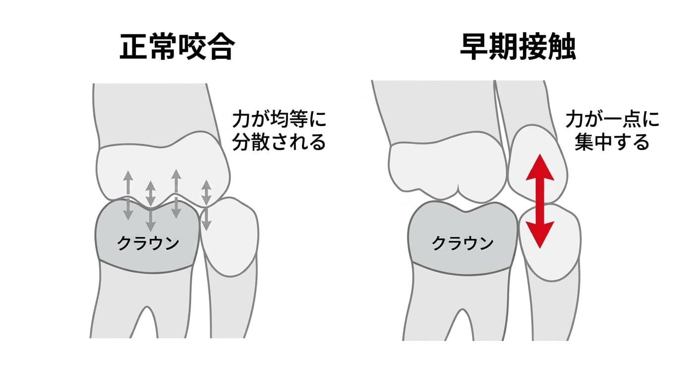 クラウンを被せた下の歯と上の歯が複数の点で均等に噛み合い、力が分散される正常咬合と、一点だけが先に当たって力が集中する早期接触を並べて比較した断面図