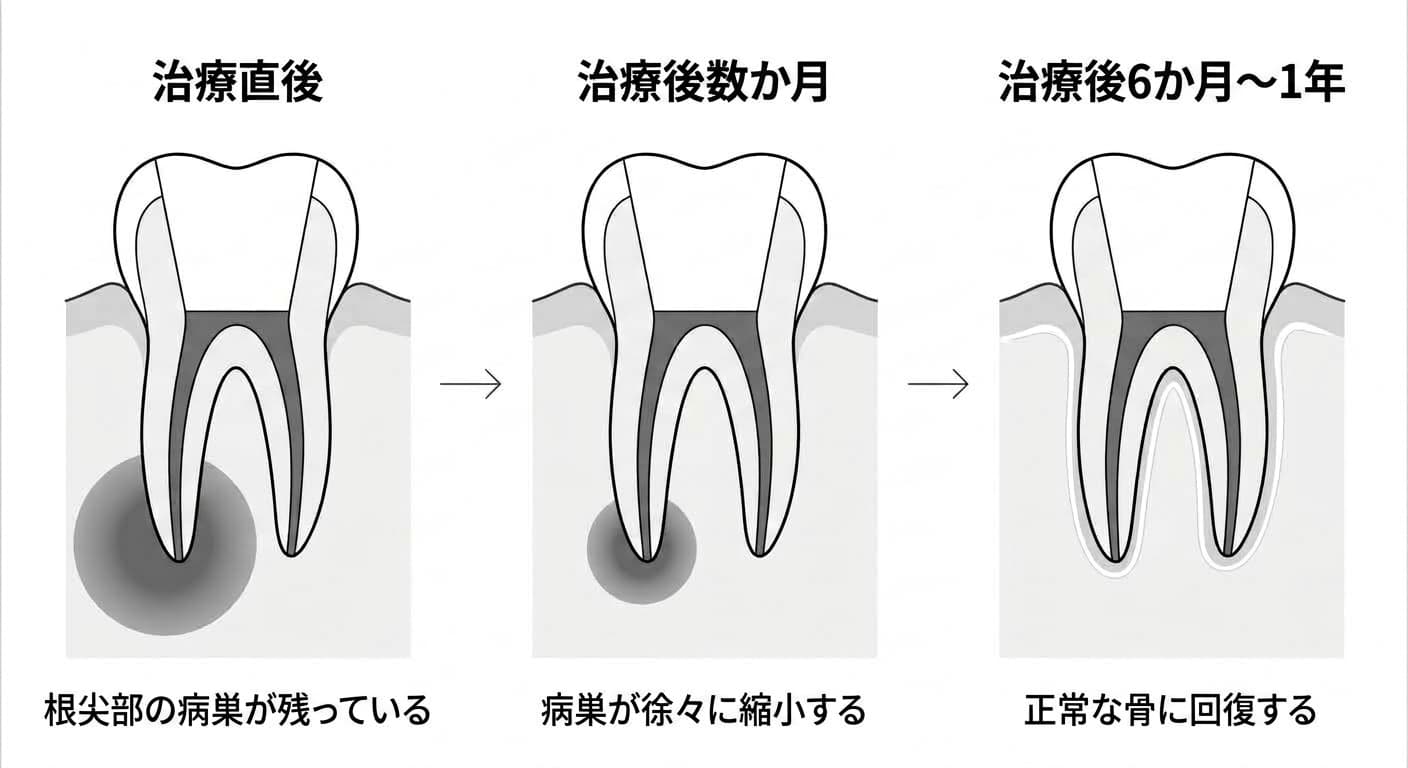 神経治療後、根の先端の病巣が治療直後、数か月後、6か月から1年後にかけて徐々に小さくなり、正常な骨に回復する過程を3段階で比較した歯の断面図
