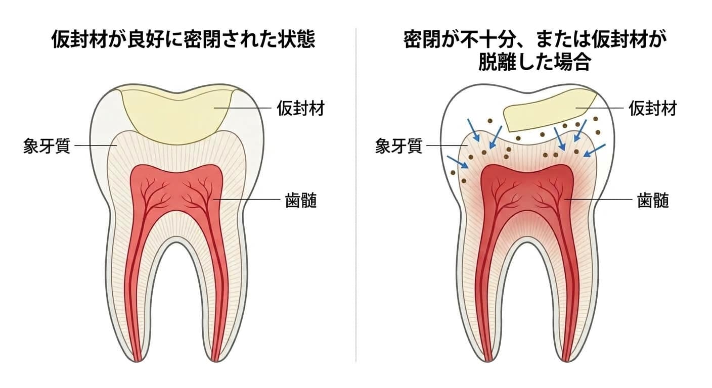 仮封材が辺縁までしっかり密閉されている場合と、辺縁が浮いて象牙質が露出している場合を並べて比較し、刺激や細菌侵入のリスクの違いを示す比較図