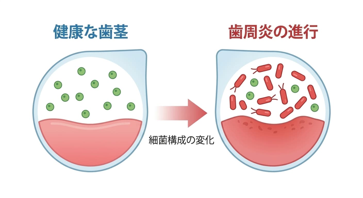 健康な歯茎と歯周炎が進行した状態の細菌構成の変化を比較した図。健康な側は緑色の細菌が均等に広がっており、歯周炎が進行した側は赤色の細菌が大きく増えている。