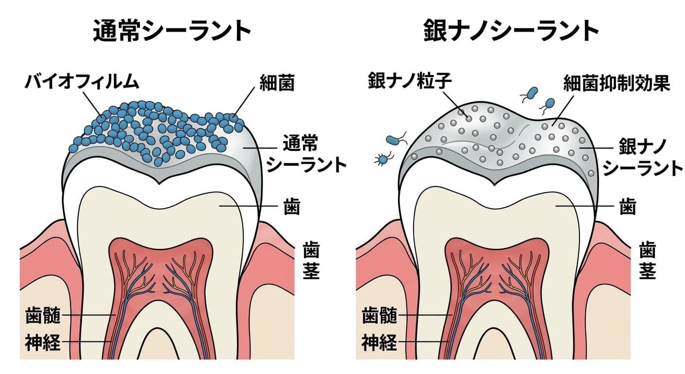 一般シーラント表面に細菌がバイオフィルムを形成して付着している様子と、銀ナノ粒子を混ぜたシーラント表面で細菌が減っている様子を比較した概念図