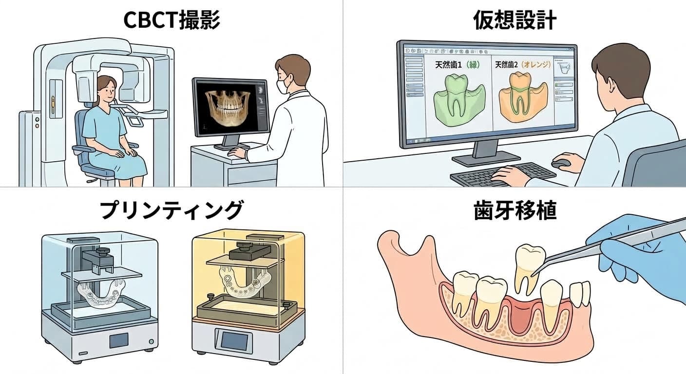 CBCTと口腔内スキャナーのデータを重ねてソケットを仮想的に設計し、3Dプリンティングガイドで歯を移植する4段階の過程