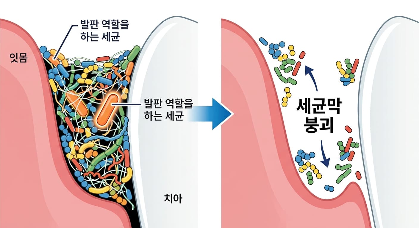 잇몸 틈 속 세균막에서 발판 역할을 하는 세균 하나만 사라지면 나머지 세균이 흩어지며 막 전체가 무너지는 개념도