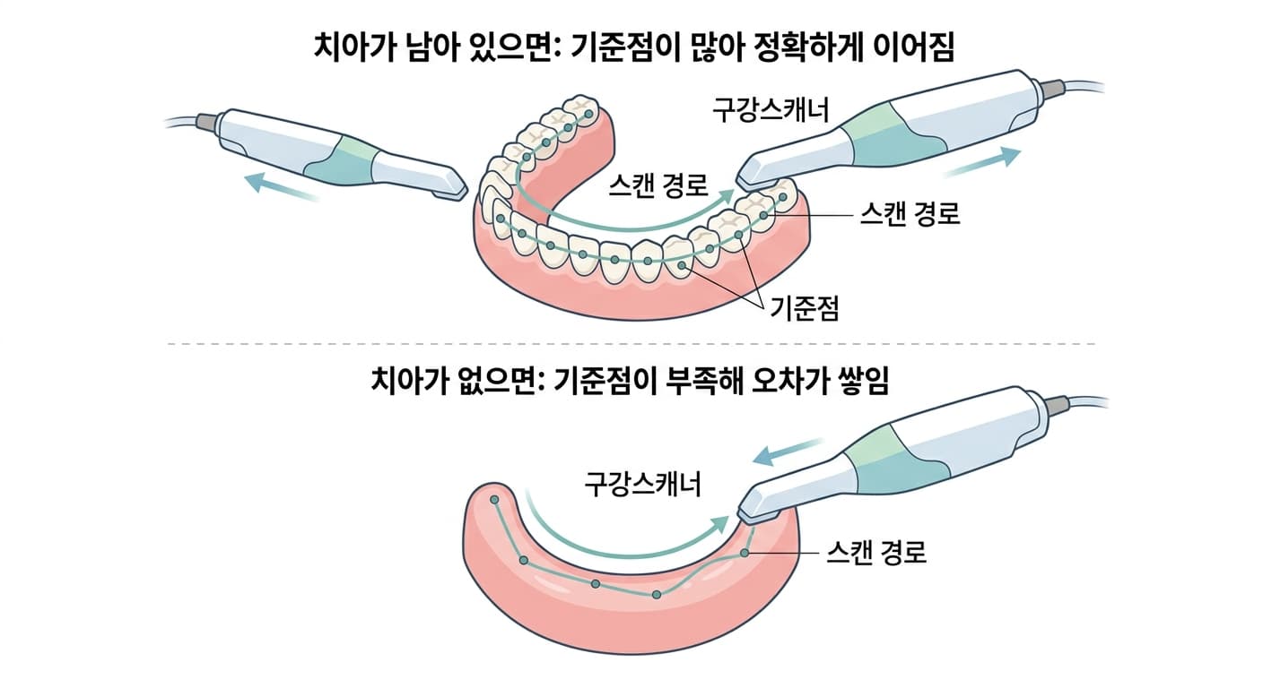 치아가 남아 있을 때와 없을 때 구강스캐너의 스캔 경로가 기준점을 따라 이어지는 방식이 어떻게 다른지 비교한 그림
