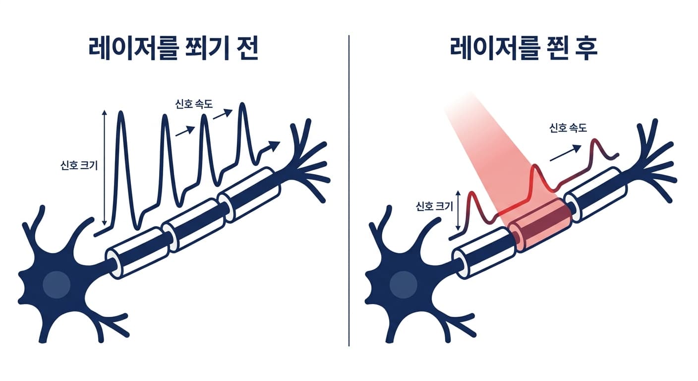레이저를 쬐기 전과 후 신경 섬유를 타고 흐르는 전기 신호의 크기와 속도 변화를 비교한 도식