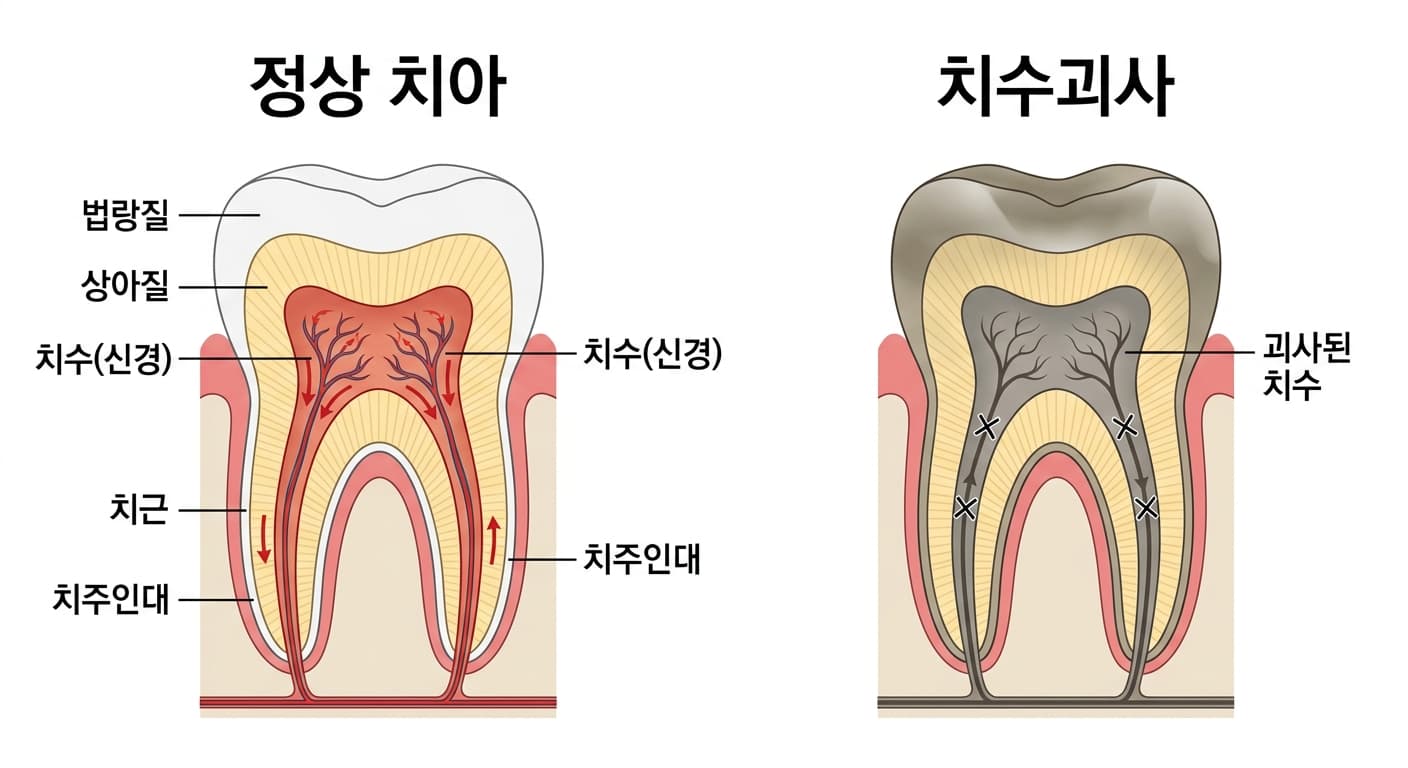 정상 치아와 치수괴사 치아의 단면 비교. 정상 치아는 치수에 혈류가 흐르지만 치수괴사 치아는 혈류가 끊기고 치수가 회색으로 죽어 있다