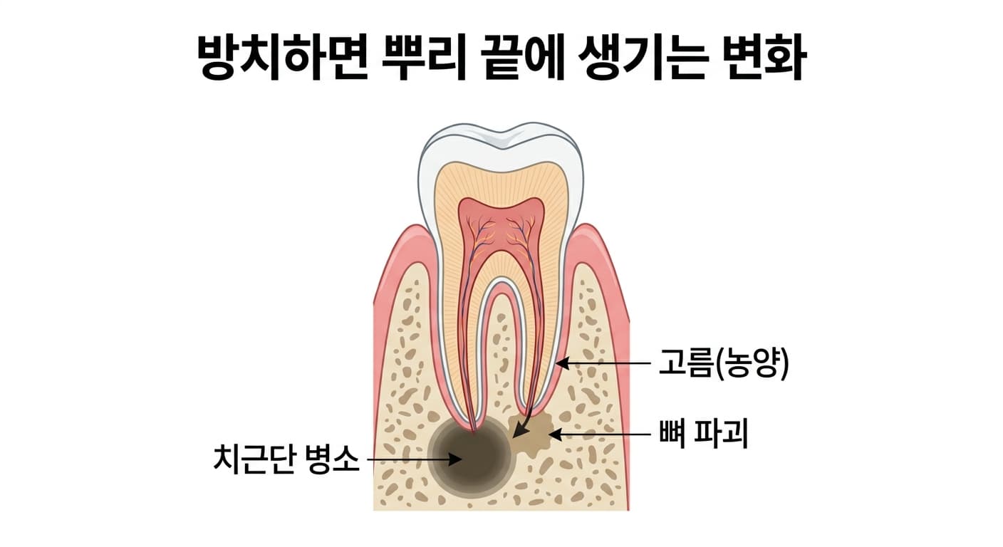 방치된 치수괴사가 뿌리 끝 뼈에 만든 병소와 고름을 보여주는 단면도