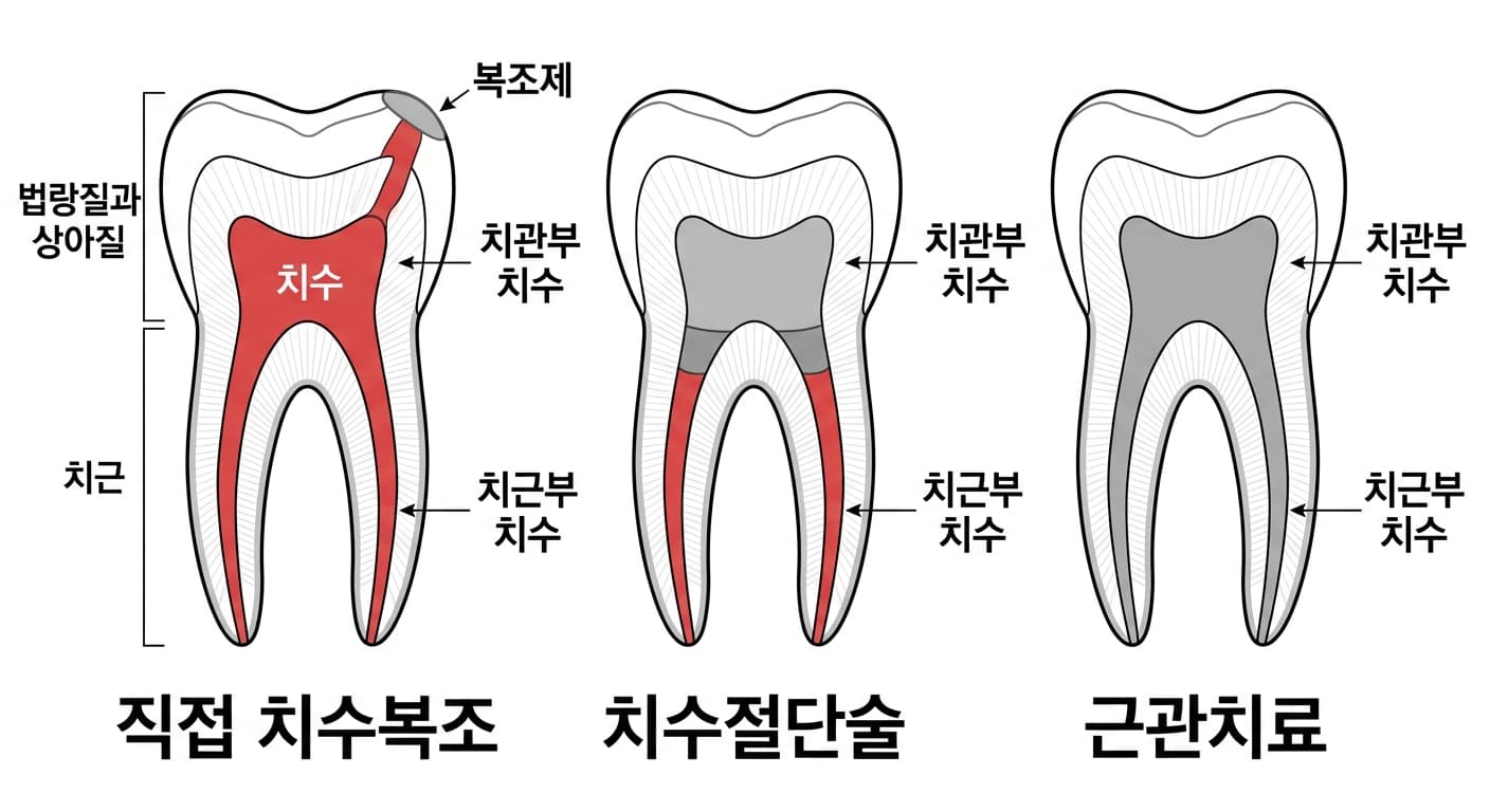 직접 치수복조, 치수절단술, 근관치료에서 남기거나 제거하는 치수 범위를 비교한 치아 단면도