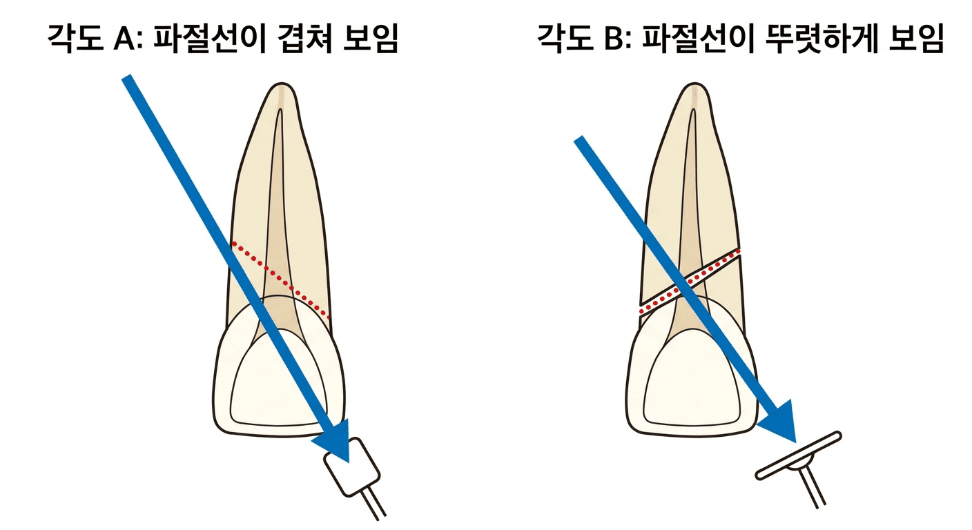 엑스레이 촬영 각도에 따라 사선으로 난 치근 파절선이 겹쳐 보이거나 뚜렷하게 보이는 모습을 비교한 그림