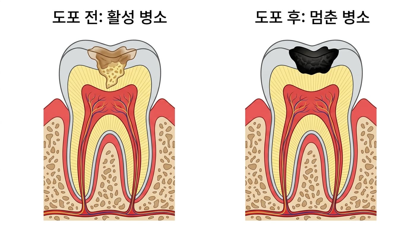 충치 병소에 SDF를 바르기 전과 두 차례 바른 뒤를 비교한 치아 단면도. 도포 전에는 갈색으로 물러진 병소가, 도포 후에는 단단하고 검게 굳은 병소가 보인다.